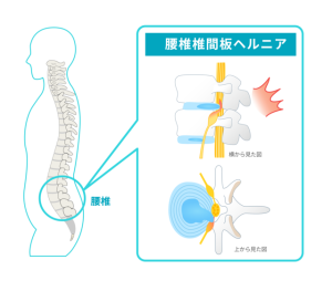 腰椎ヘルニアのメカニズム